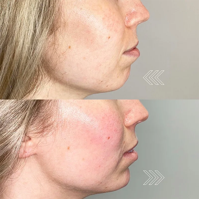 Before and after profile comparison of facial skin treatment results