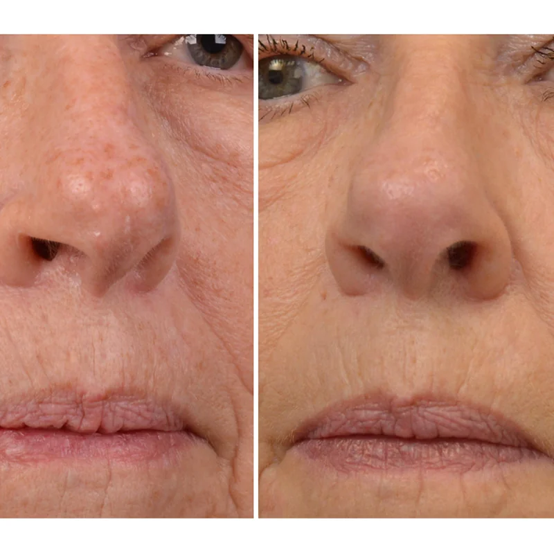Before and after comparison of facial skin treatment showing improved texture and appearance