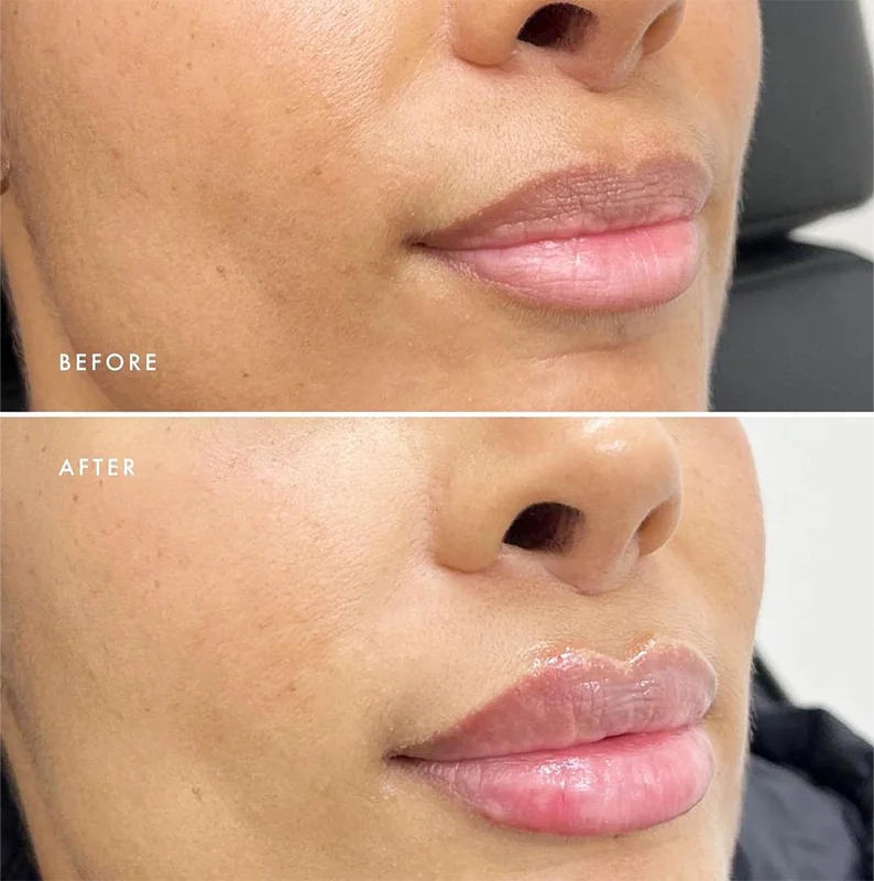 Before and after comparison of lip augmentation showing increased lip fullness and definition