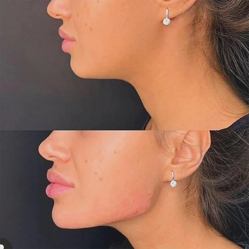 Side profile comparison of chin augmentation before and after results