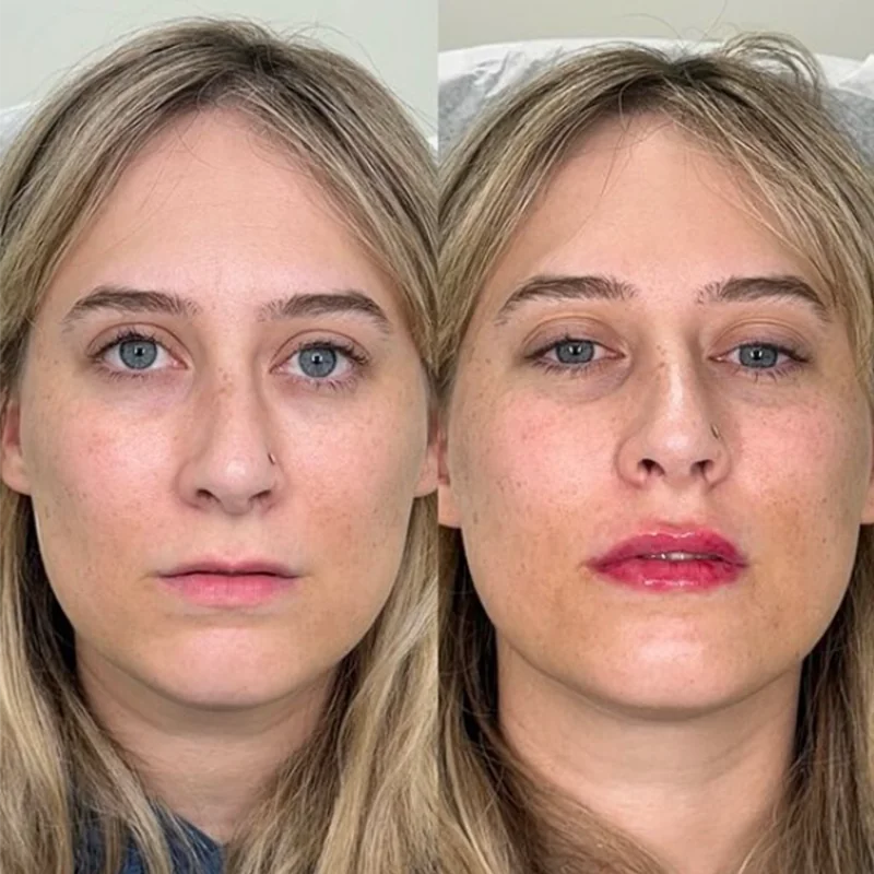 Before and after comparison of lip enhancement treatment on a woman's face