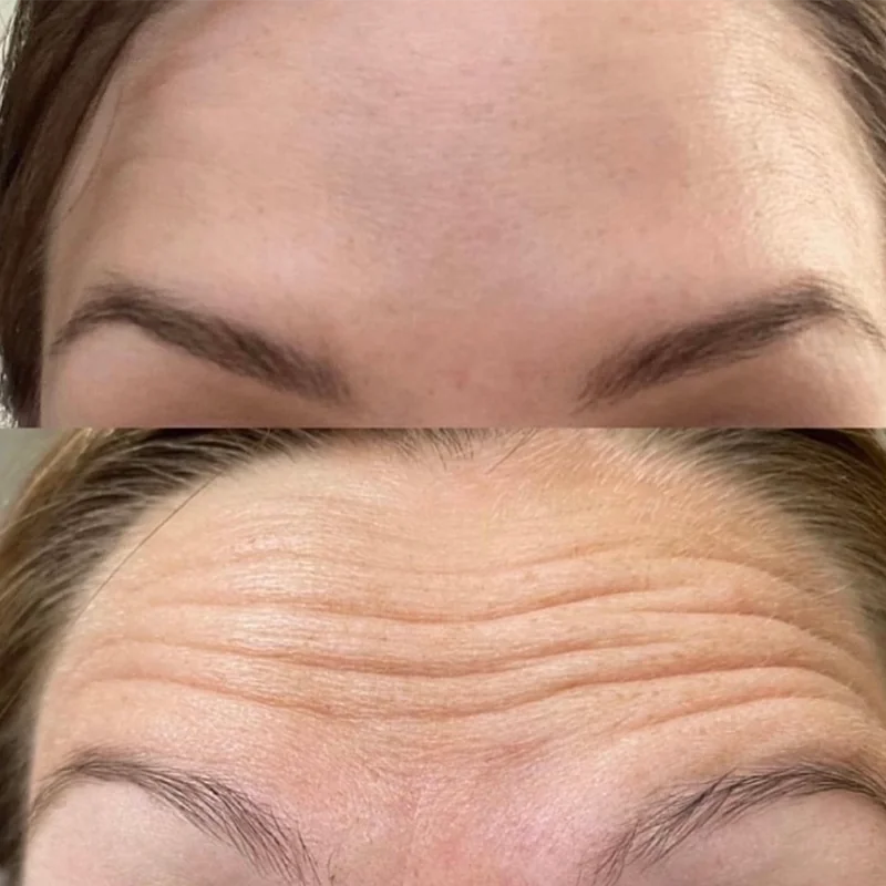 Before and after comparison of forehead skin texture and wrinkles