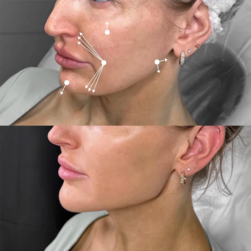 Before and after facial contouring treatment with mapped injection points on lower face and jawline