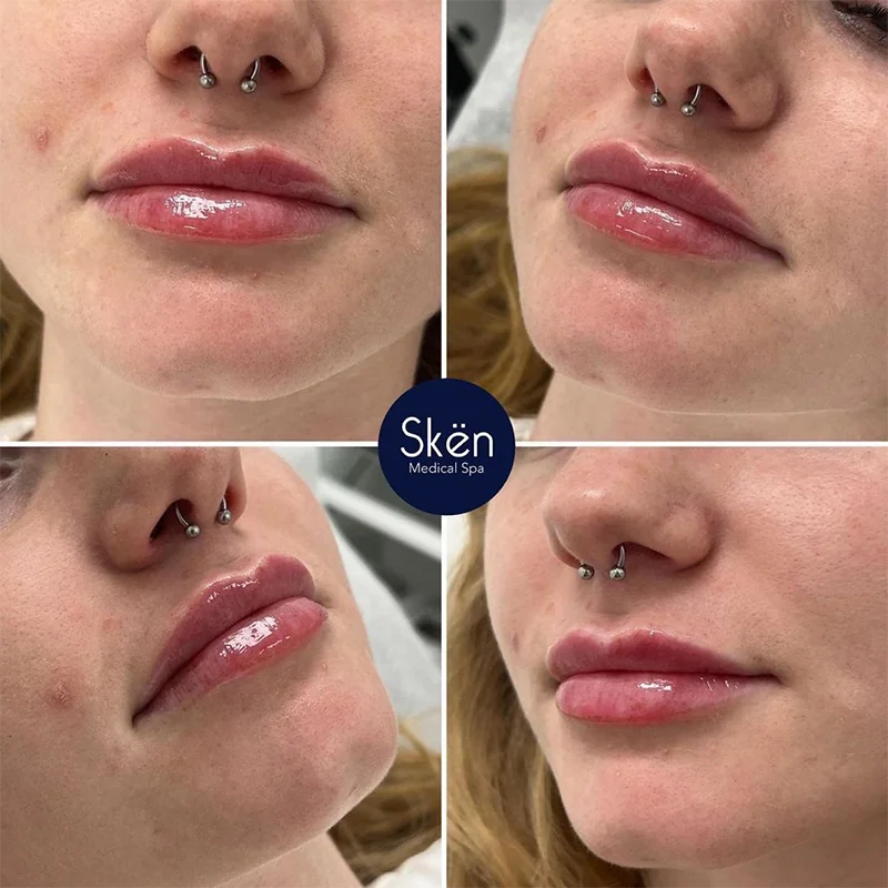 Four close-up views of lips showing before and after lip filler treatment results
