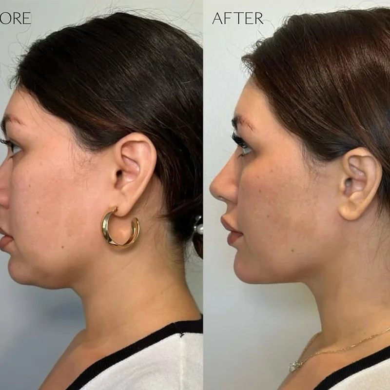 Before and after profile comparison showing facial contouring results