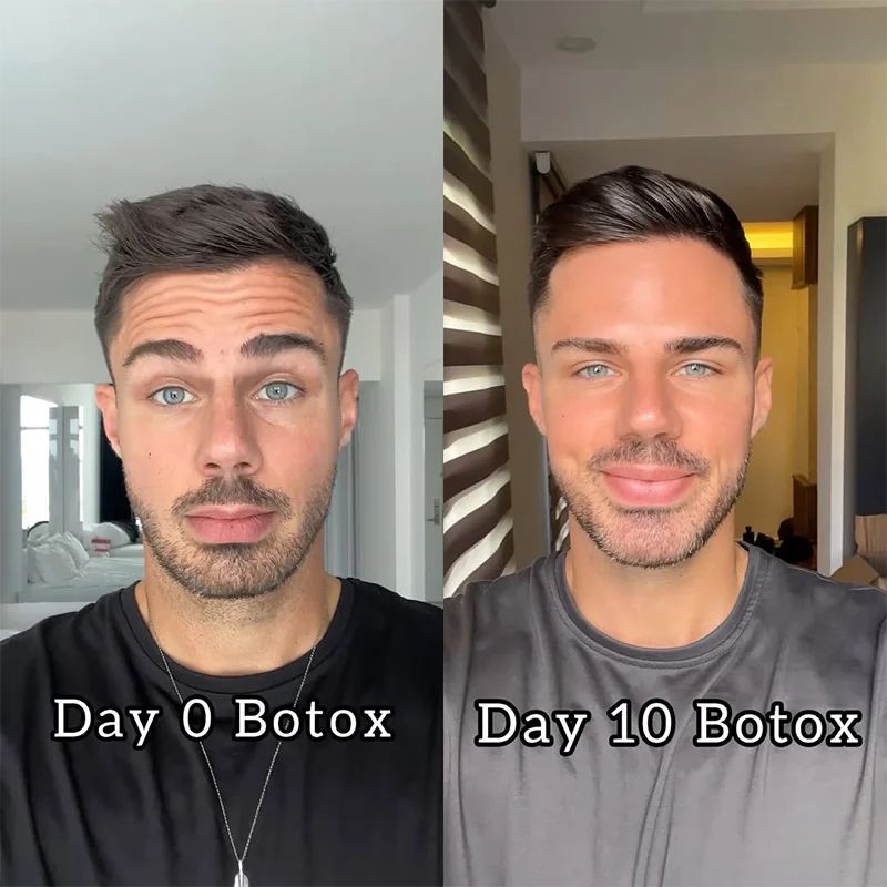 Before and after Botox comparison on male face at day 0 and day 10