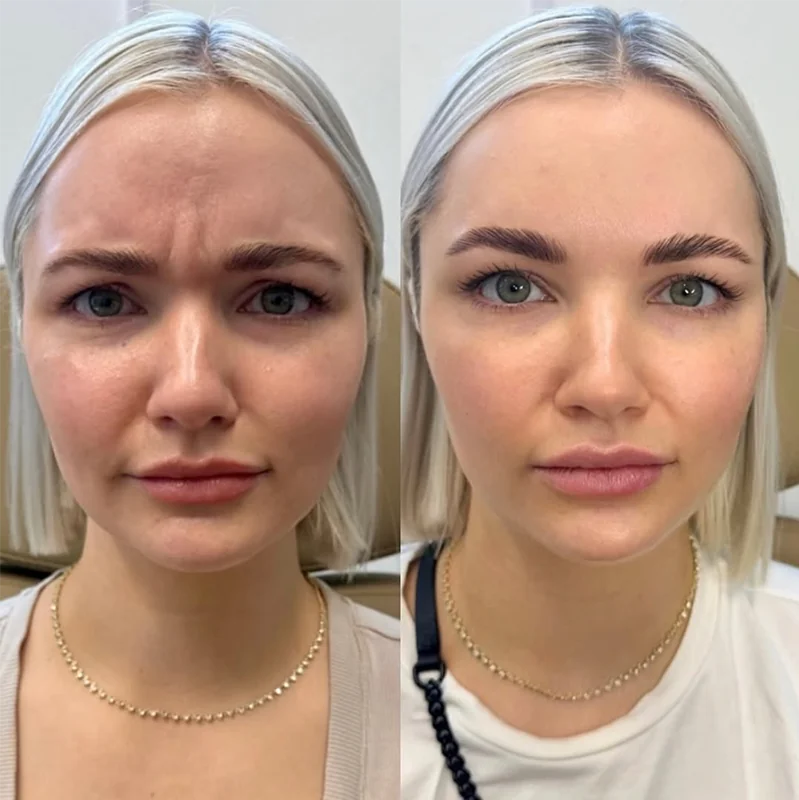 Before and after comparison showing natural Botox wrinkle reduction results