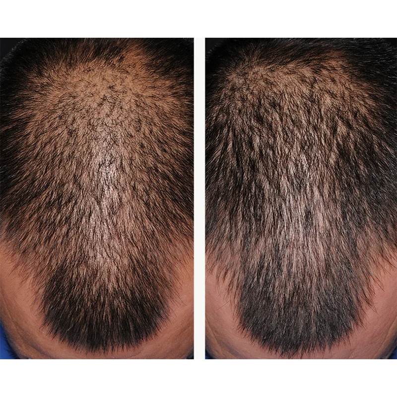 Before and after comparison of scalp hair density showing thinning on left side and fuller hair on right side