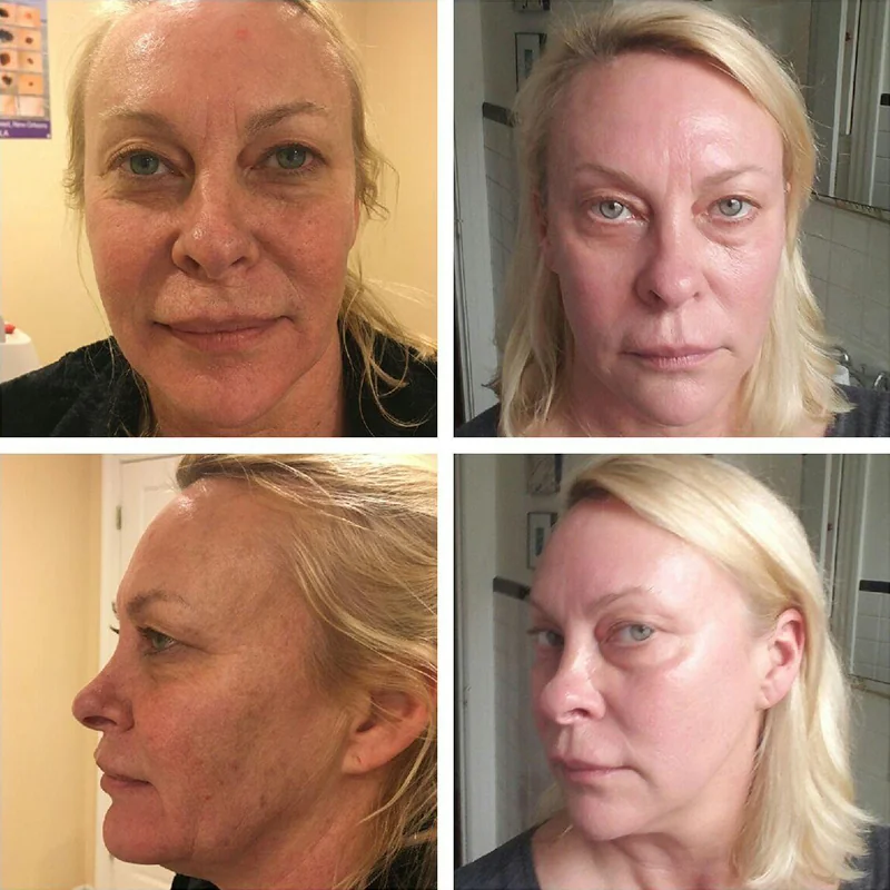 Before and after facial treatment comparison showing frontal and side profile views