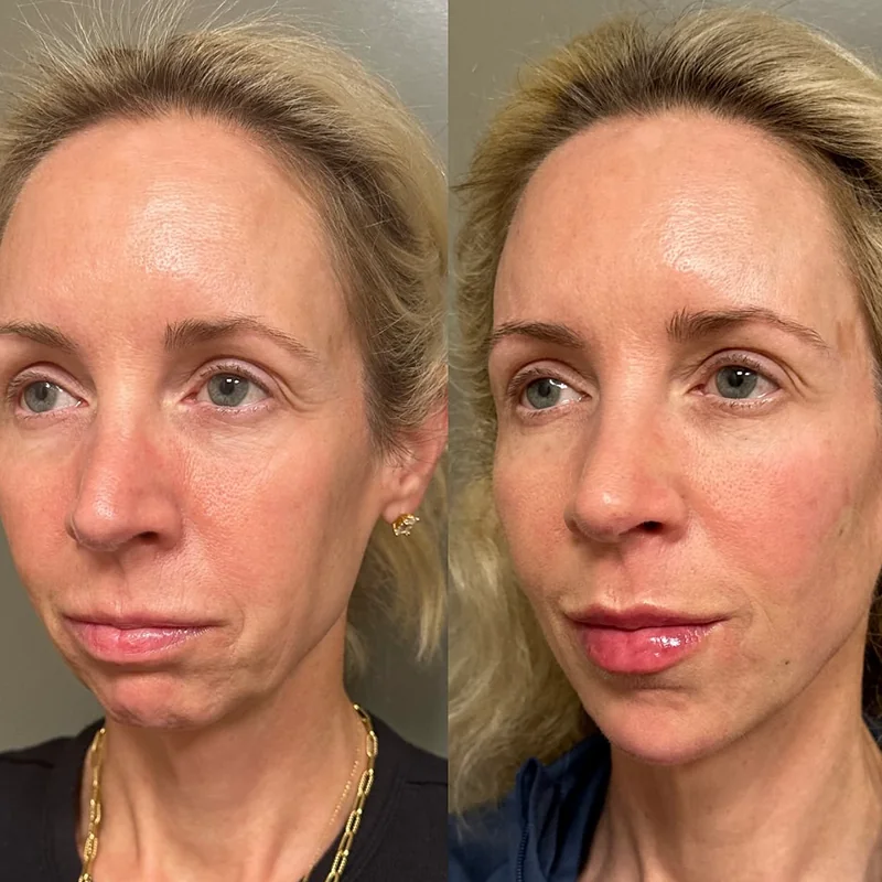 Before and after facial treatment comparison showing improved skin texture and definition