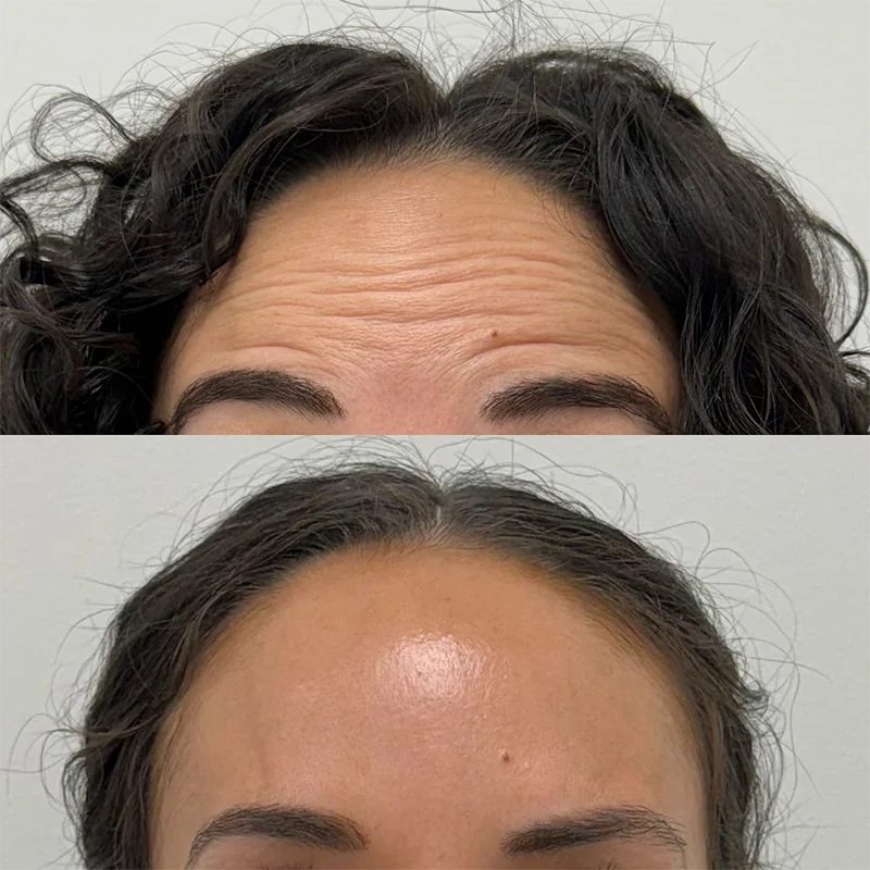 Before and after comparison of forehead wrinkles and skin texture on upper face