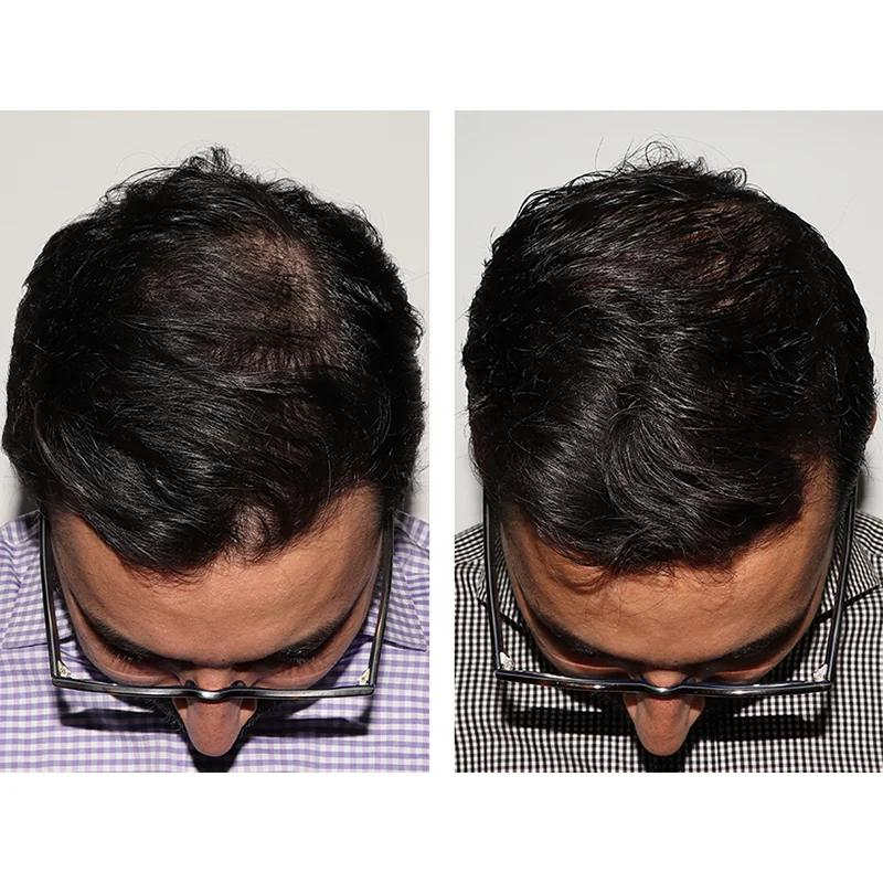 Before and after overhead view of hair treatment results on male patient