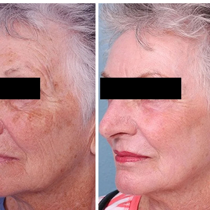 Before and after comparison of facial skin treatment showing improved texture and reduced wrinkles