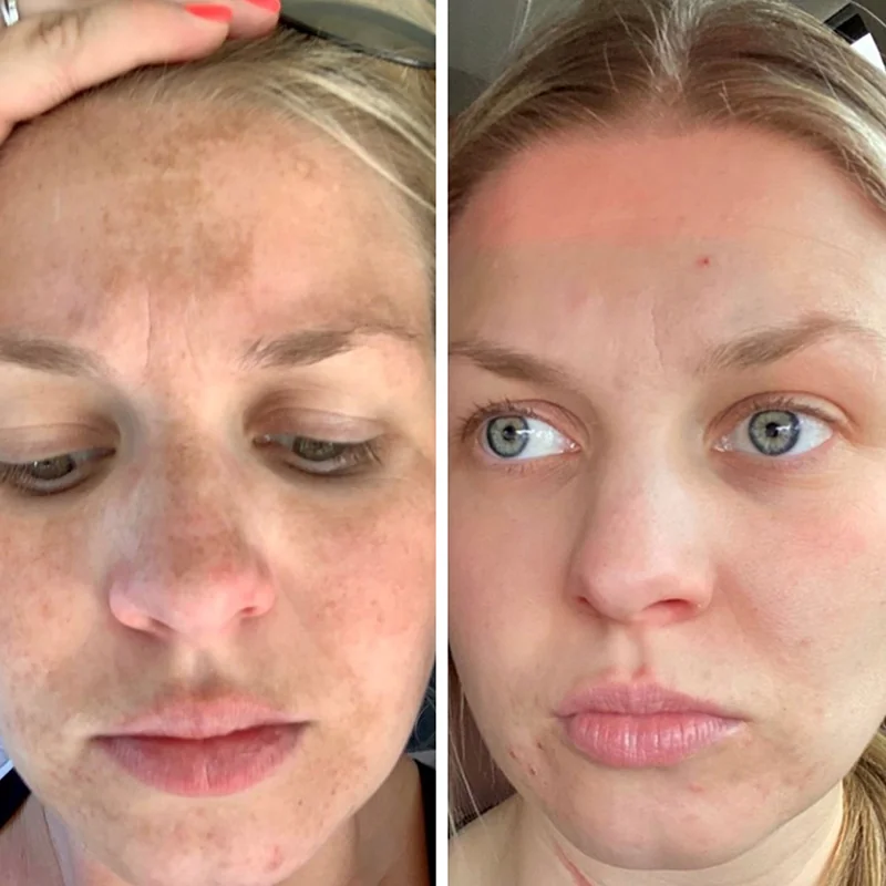 Before and after comparison of facial skin treatment results showing improved skin tone and clarity