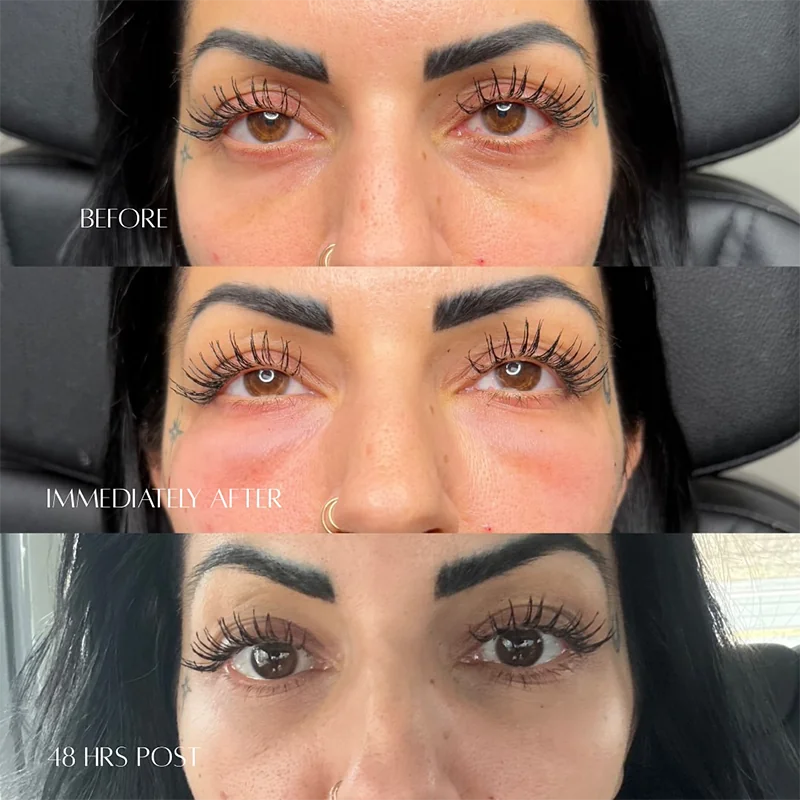 Before and after under-eye treatment comparison showing reduced puffiness at immediate and 48-hour intervals
