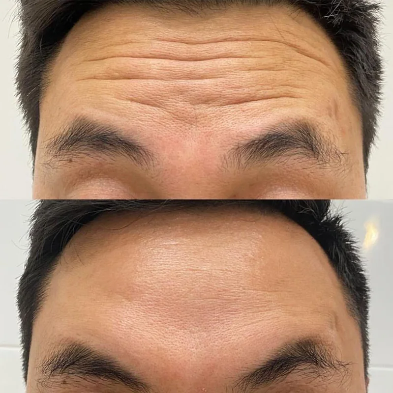 Before and after comparison of forehead wrinkles treatment results on a person's forehead