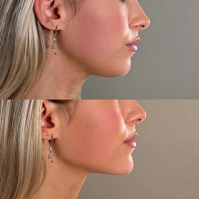 Before and after profile comparison of facial contouring results on a woman with gray hair