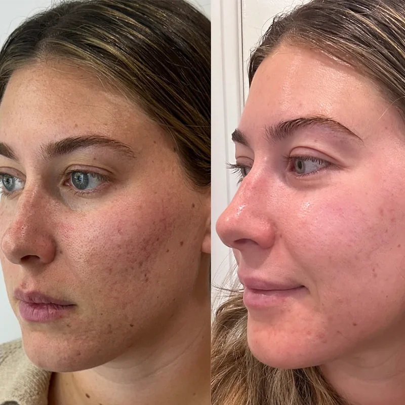 Before and after comparison of facial skin treatment showing improved complexion on right side