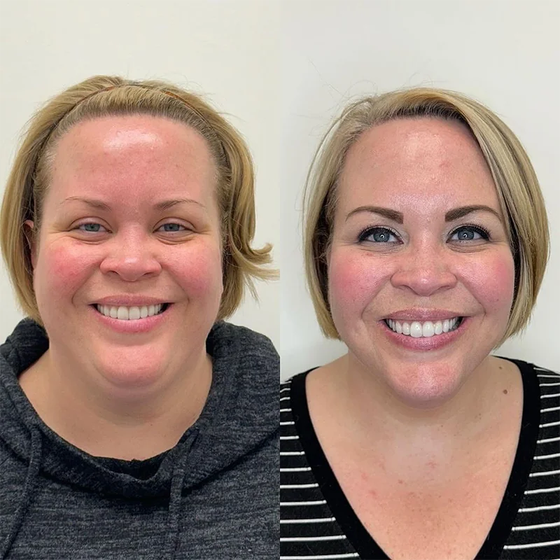 Woman's before and after portrait comparison showing facial transformation results
