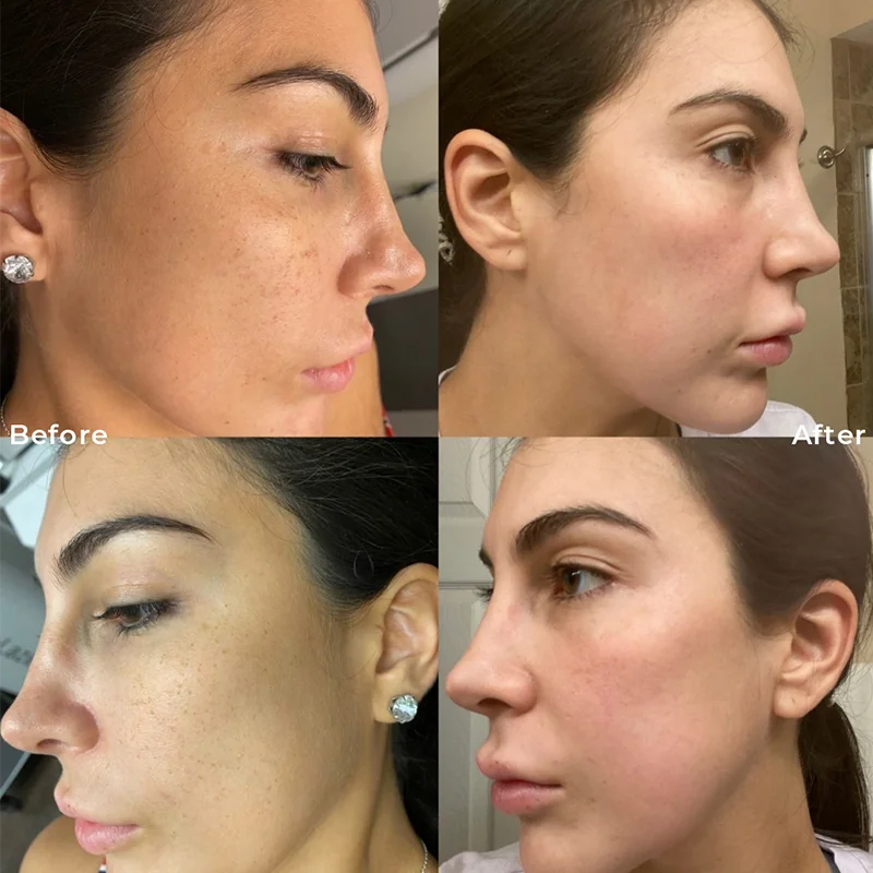 Before and after facial contouring results shown in profile views from different angles