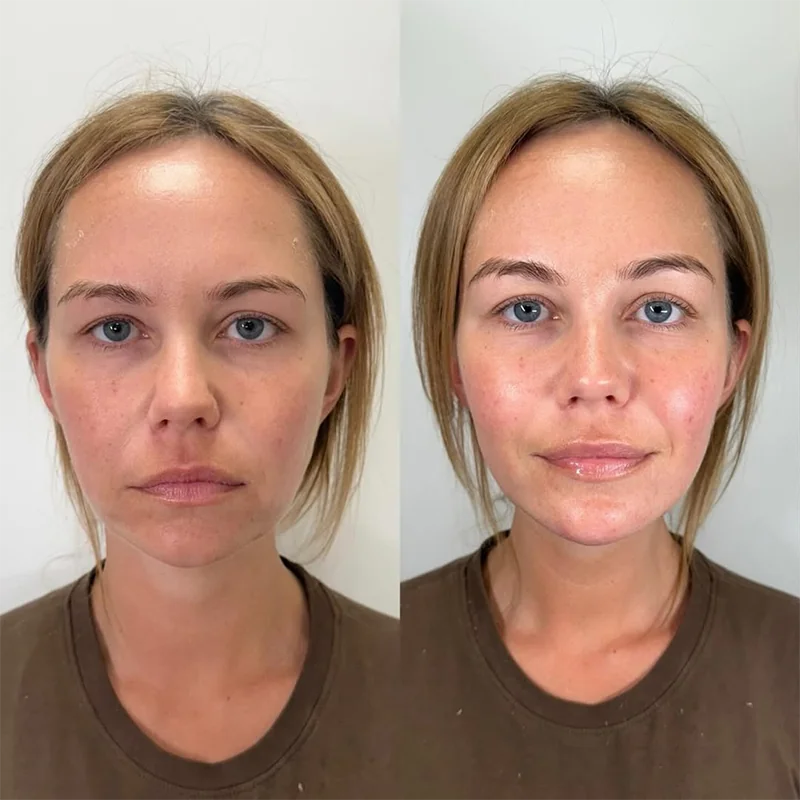 Before and after facial treatment comparison showing skin improvement