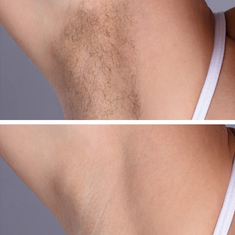 Before and after comparison of hair removal treatment on skin