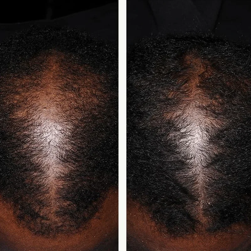 Side-by-side comparison of scalp showing hair density difference between two treatment or time states