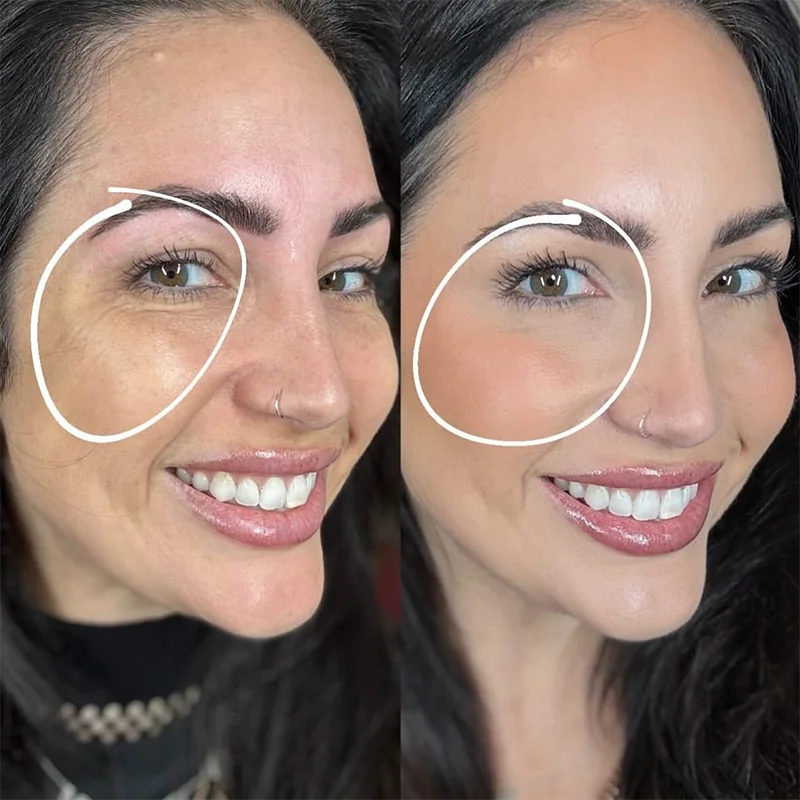 Before and after comparison of under-eye area treatment results showing reduced bags and darkness