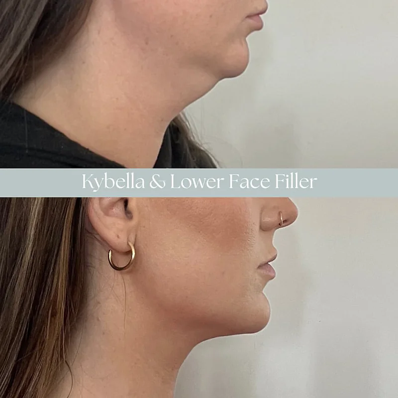 Side profile comparison of face before and after kybella and lower face filler treatment