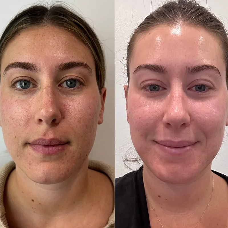 Before and after facial comparison showing skin texture and complexion improvement