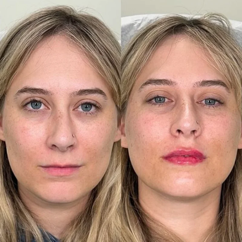 Before and after photos of lip enhancement procedure on same person
