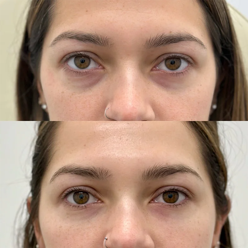Before and after comparison of under-eye area showing reduced bags and swelling