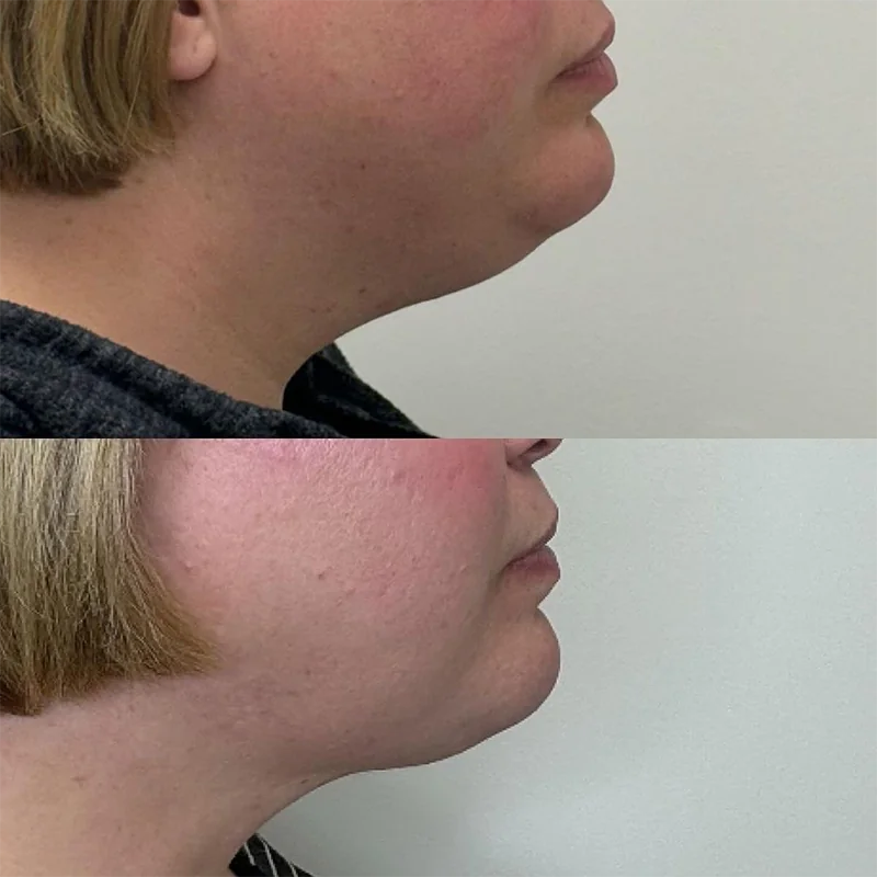 Side profile comparison of chin and jawline showing before and after results