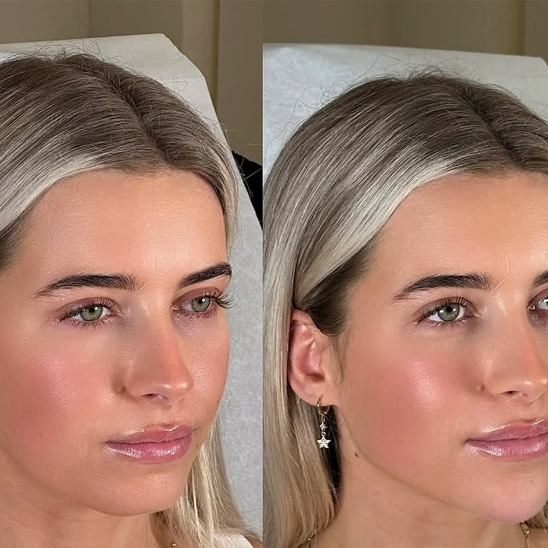 Before and after comparison of facial skin treatment results showing improved complexion and skin clarity