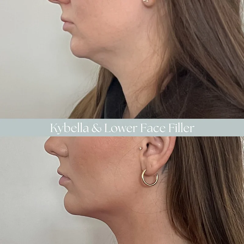 Side profile comparison of facial contouring results from Kybella and lower face filler treatment