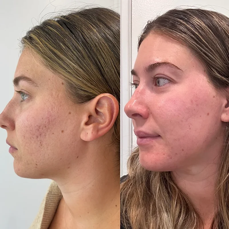 Side-by-side profile comparison of a woman's face showing facial structure and features