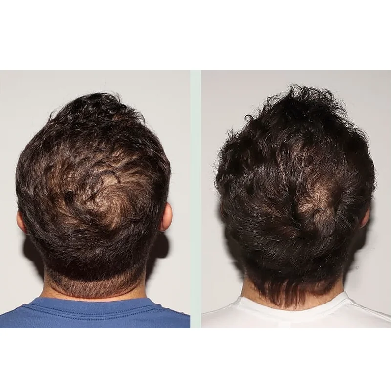 Back view comparison of male hair loss severity on left versus improved hair density on right