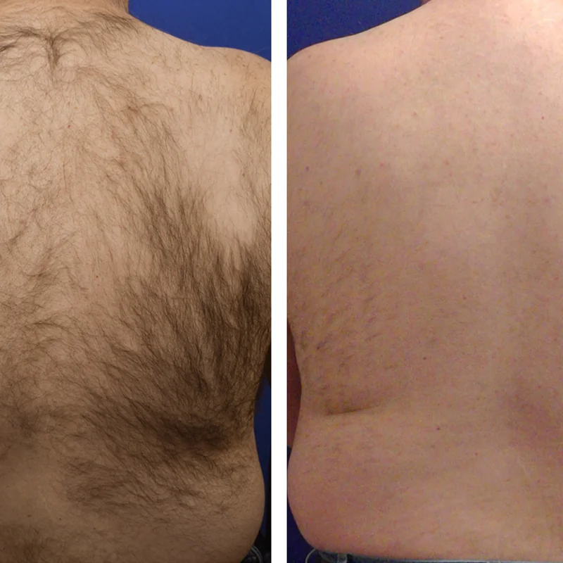 Before and after comparison of back hair removal treatment results