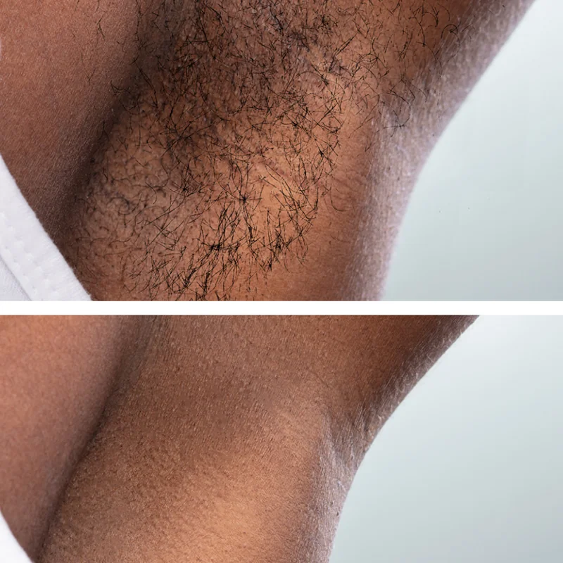 Before and after comparison of hair removal treatment on skin