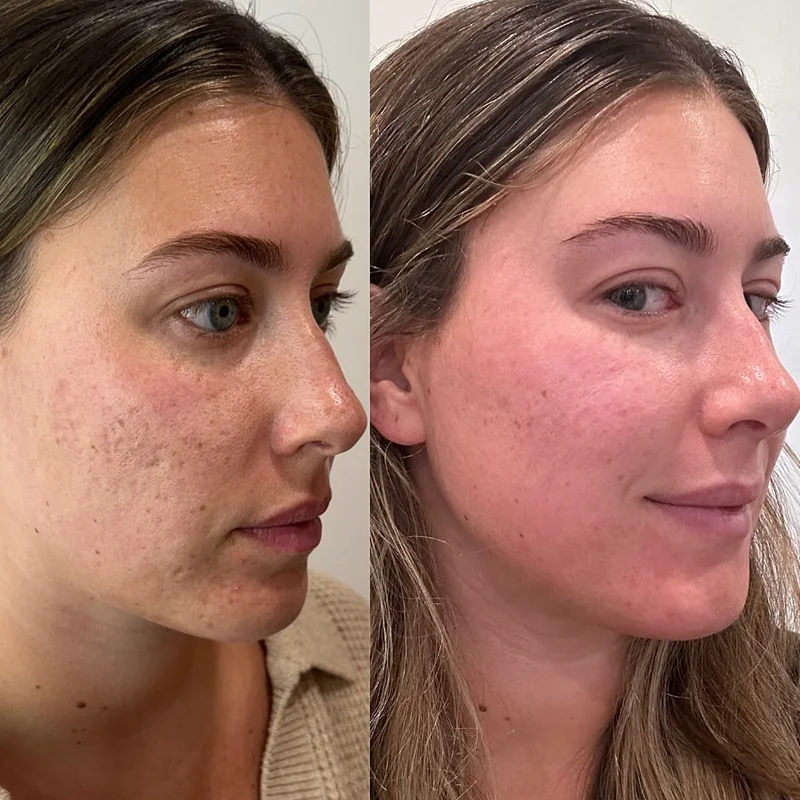 Before and after profile views of a woman's face showing facial changes