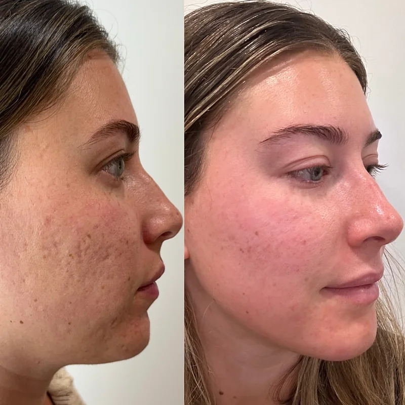 Before and after profile view of facial treatment results showing skin improvement