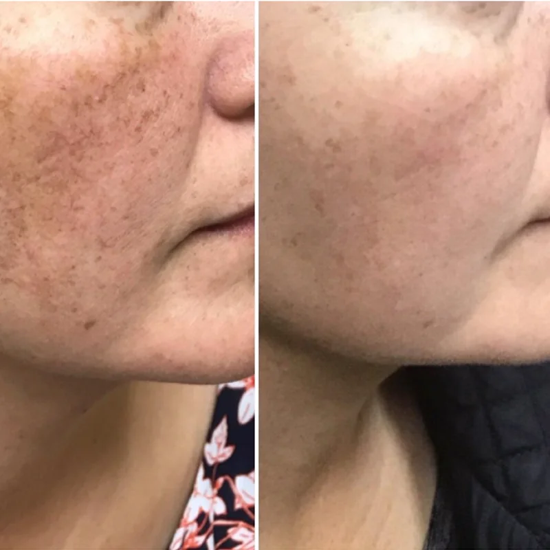 Before and after skin treatment results showing improved complexion and reduced blemishes on lower face