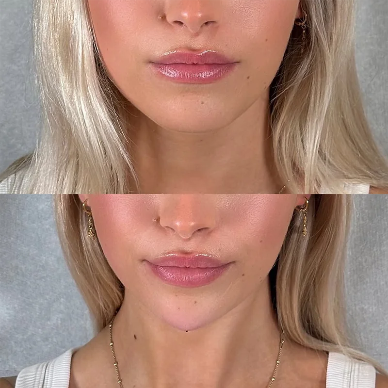 Before and after lip filler treatment showing enhanced lip volume and definition