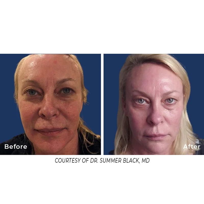 Before and after comparison of facial rejuvenation treatment results by Dr. Summer Black, MD