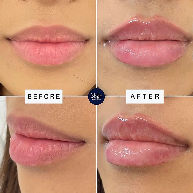 Before and after comparison of lip enhancement treatment showing fuller lips with increased volume and glossy finish