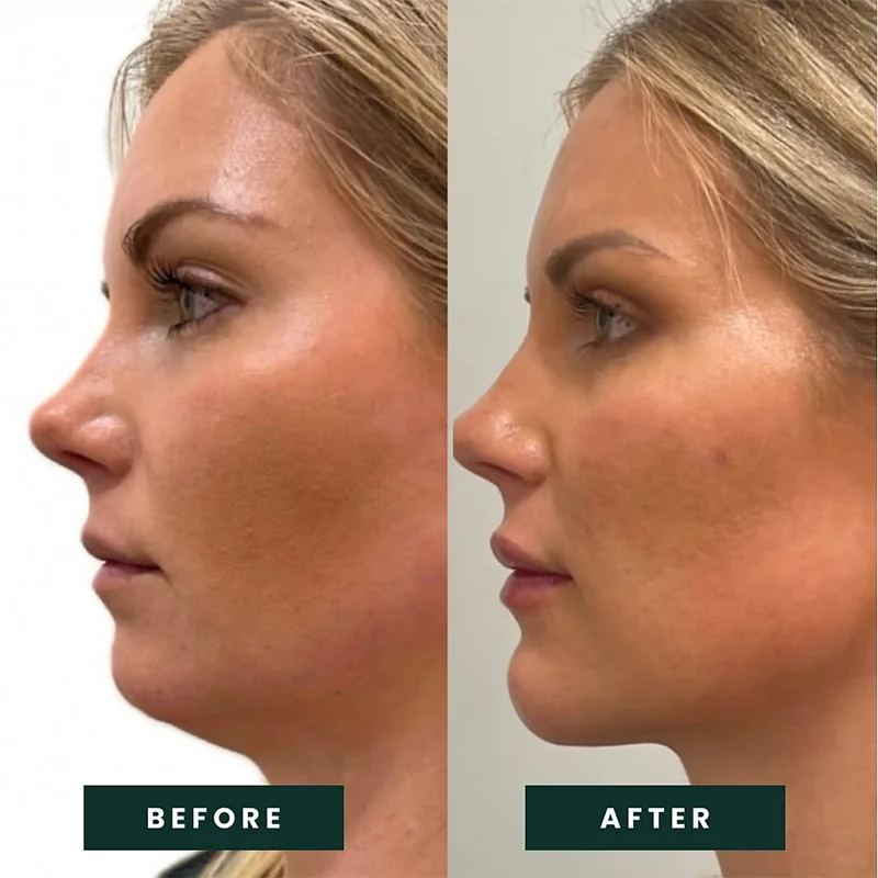 Before and after profile views comparing lip fullness and definition from cosmetic enhancement