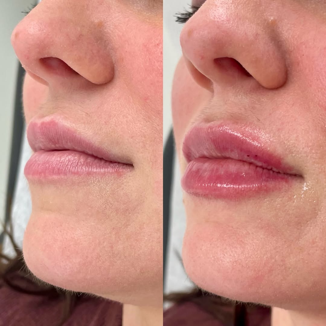 Before and after comparison of lip augmentation results showing enhanced lip volume and definition