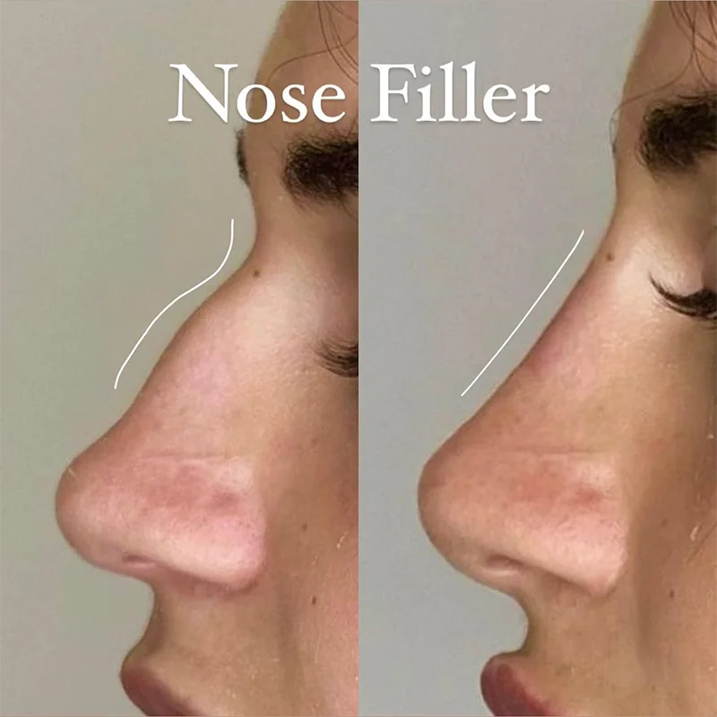 Before and after side profile showing nose filler results with enhanced bridge definition