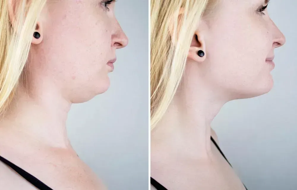 Side-by-side profile comparison showing neck and jawline before and after cosmetic treatment, with improved definition and reduced sagging on the right.