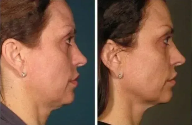Side-by-side profile comparison showing neck and jawline before and after cosmetic treatment or procedure.